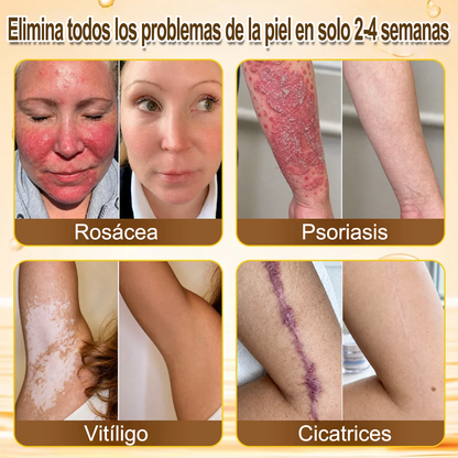 ✨🐝 Purelora® Crema de Reposición de Crema de Sol de Monocromo (Un solo producto para reposición) 𝐢𝐧𝐟𝐥𝐚𝐦𝐦𝐚𝐭𝐢𝐨𝐧, 𝐝𝐫𝐲𝐧𝐞𝐬𝐬, 𝐚𝐠𝐢𝐧𝐠, 𝐩𝐢𝐠𝐦𝐞𝐧𝐭𝐚𝐭𝐢𝐨𝐧, 𝐚𝐧𝐝 𝐯𝐢𝐬𝐢𝐛𝐥𝐞 𝐬𝐤𝐢𝐧 𝐝𝐚𝐦𝐚𝐠𝐞.)
