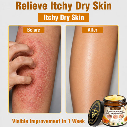 ✨🐝𝐇𝐈𝐒𝐊𝐈𝐍® 𝐌𝐮𝐥𝐭𝐢-𝐂𝐨𝐧𝐜𝐞𝐫𝐧 𝐒𝐤𝐢𝐧 𝐑𝐞𝐩𝐚𝐢𝐫 𝐂𝐫𝐞𝐚𝐦 (𝐎𝐧𝐞 𝐩𝐨𝐰𝐞𝐫𝐟𝐮𝐥 𝐜𝐫𝐞𝐚𝐦 𝐭𝐨 𝐫𝐞𝐩𝐚𝐢𝐫 𝐢𝐧𝐟𝐥𝐚𝐦𝐦𝐚𝐭𝐢𝐨𝐧, 𝐝𝐫𝐲𝐧𝐞𝐬𝐬, 𝐚𝐠𝐢𝐧𝐠, 𝐩𝐢𝐠𝐦𝐞𝐧𝐭𝐚𝐭𝐢𝐨𝐧, 𝐚𝐧𝐝 𝐯𝐢𝐬𝐢𝐛𝐥𝐞 𝐬𝐤𝐢𝐧 𝐝𝐚𝐦𝐚𝐠𝐞.)