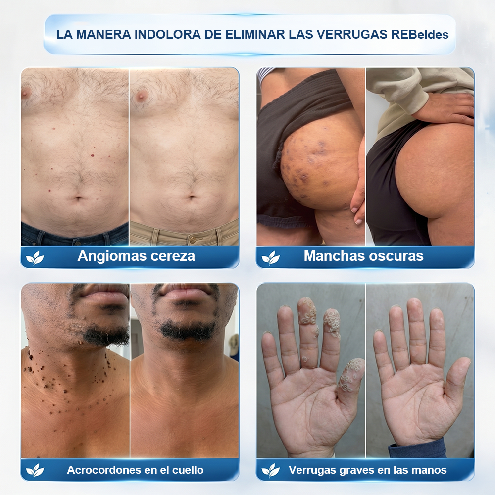 Tienda oficial de la marca | ✅💎 Purelora® Lápiz avanzado de 7 días para la eliminación segura de imperfecciones y cicatrices (aplicador roll-on: sin dolor ni cicatrices)