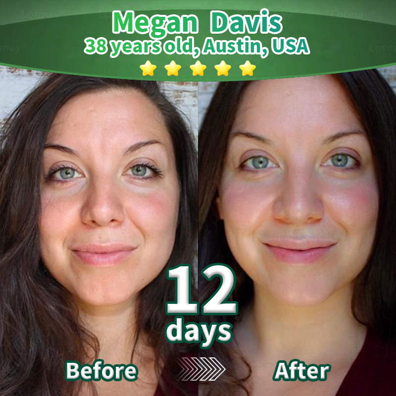 Purelora® Stem Cell–Derived EGF & Copper Peptide Activating Serum  (Deeply activates skin renewal from within for firmer, smoother-looking skin)