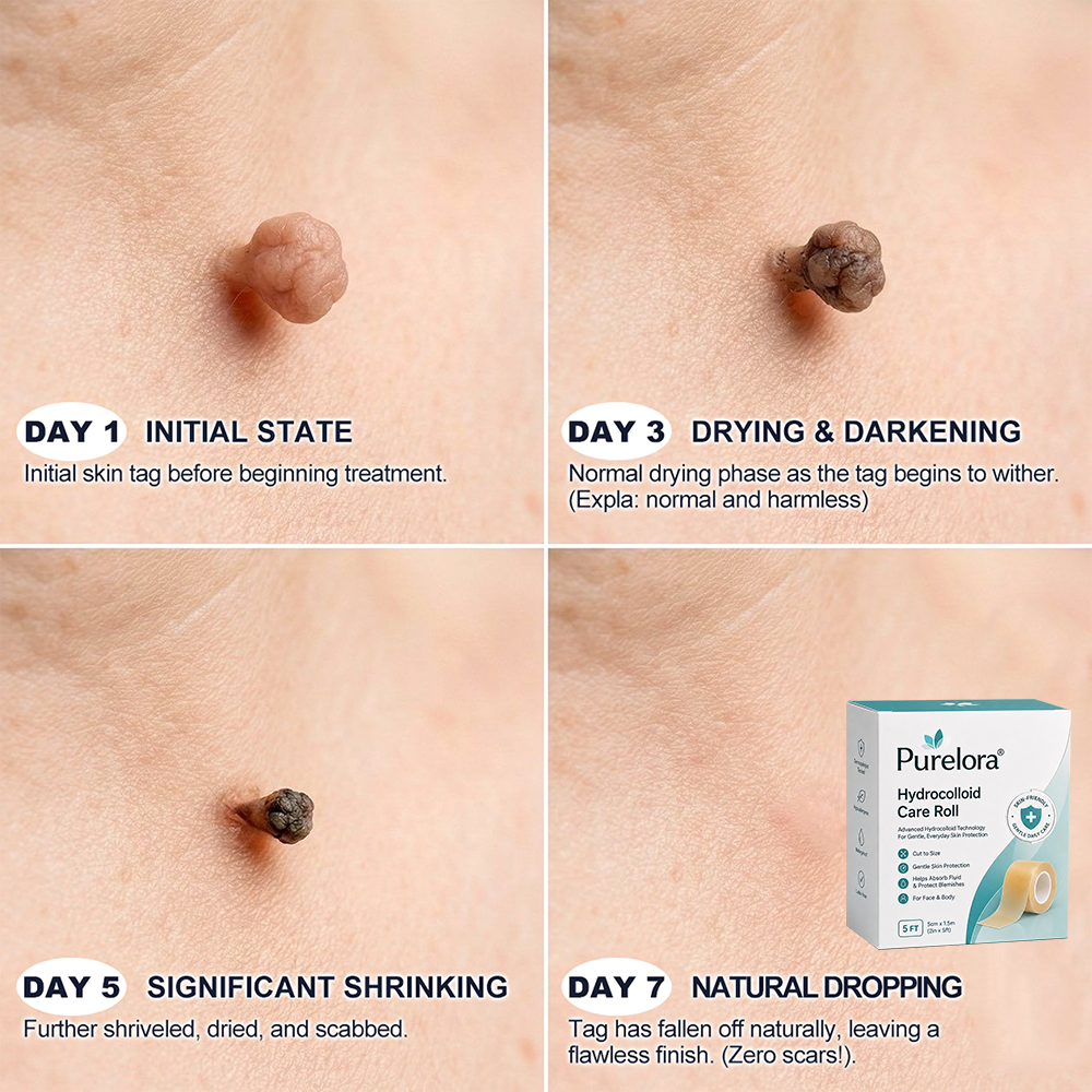 𝐎𝐟𝐟𝐢𝐜𝐢𝐚𝐥 𝐁𝐫𝐚𝐧𝐝 𝐒𝐭𝐨𝐫𝐞 |✅💎Purelora® 6-in-1 Hydrocolloid Care Roll – Acne Care, Oil Control, Post-Blemish Marks, Scar Care, Visible Spot Protection & Pore Care