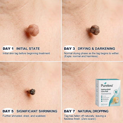 𝐎𝐟𝐟𝐢𝐜𝐢𝐚𝐥 𝐁𝐫𝐚𝐧𝐝 𝐒𝐭𝐨𝐫𝐞 |✅💎Purelora® 6-in-1 Hydrocolloid Care Roll – Acne Care, Oil Control, Post-Blemish Marks, Scar Care, Visible Spot Protection & Pore Care