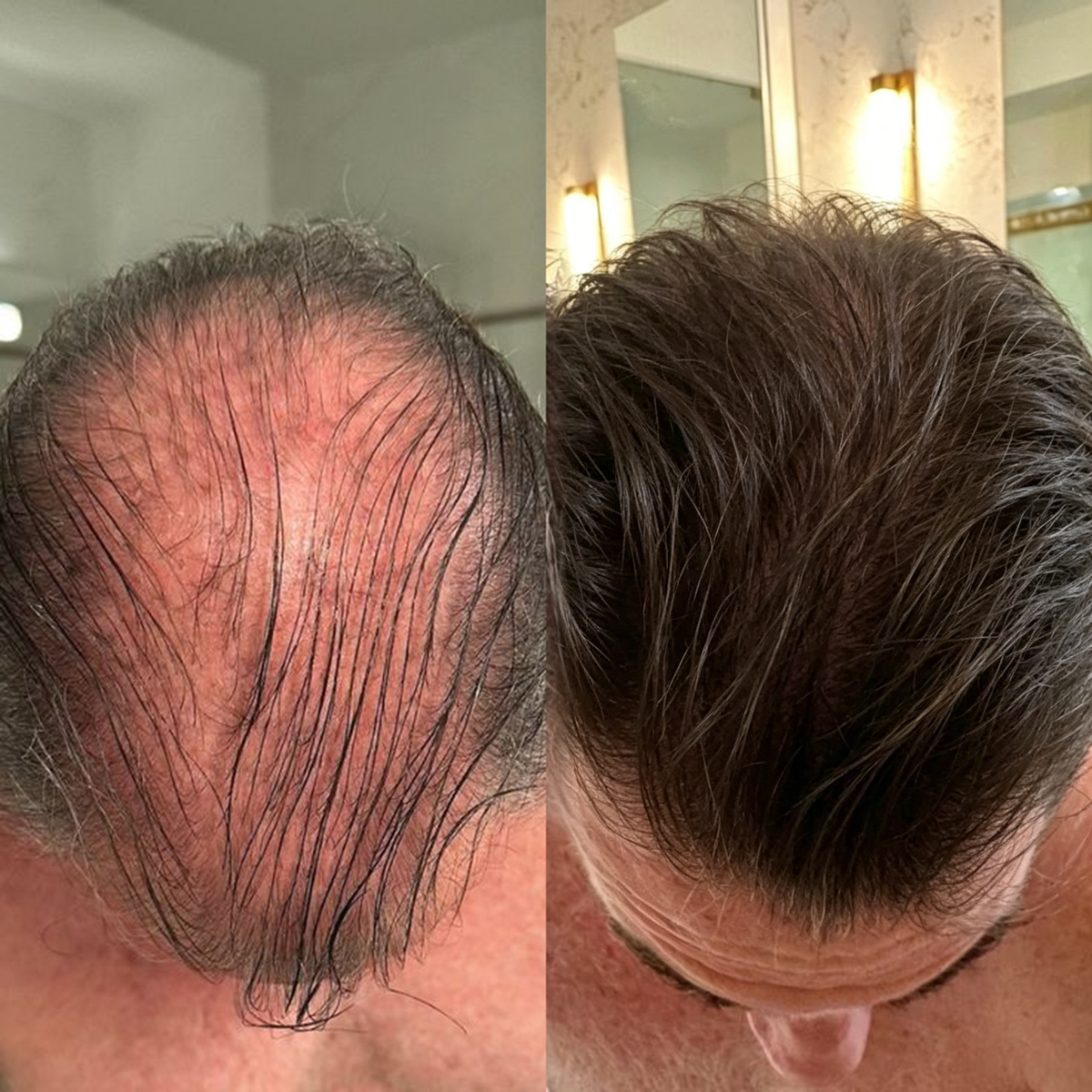 🌿👨‍⚕️ Tienda oficial en EE. UU. 🇺🇸 | 🔥 Champú y acondicionador 2 en 1 PURELORA® de cebolla y romero con complejo activo 15X para el crecimiento capilar: para un cabello con apariencia más gruesa, abundante y fuerte.