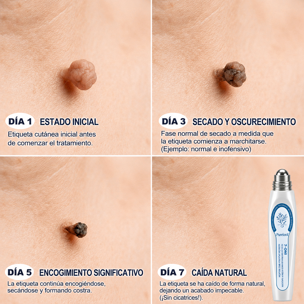 Tienda oficial de la marca | ✅💎 Purelora® Lápiz avanzado de 7 días para la eliminación segura de imperfecciones y cicatrices (aplicador roll-on: sin dolor ni cicatrices)