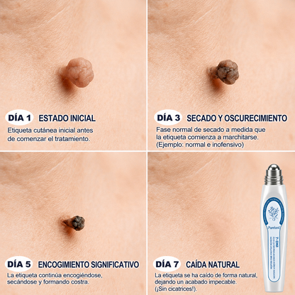 Tienda oficial de la marca | ✅💎 Purelora® Lápiz avanzado de 7 días para la eliminación segura de imperfecciones y cicatrices (aplicador roll-on: sin dolor ni cicatrices)