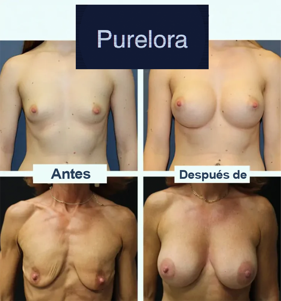 【Tienda Oficial】Purelora® Parche 5 en 1 para el Levantamiento y Reafirmación del Busto con Aceite de Bakuchiol