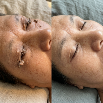 𝐎𝐟𝐟𝐢𝐜𝐢𝐚𝐥 𝐁𝐫𝐚𝐧𝐝 𝐒𝐭𝐨𝐫𝐞 |✅💎Purelora® 6-in-1 Hydrocolloid Care Roll – Acne Care, Oil Control, Post-Blemish Marks, Scar Care, Visible Spot Protection & Pore Care