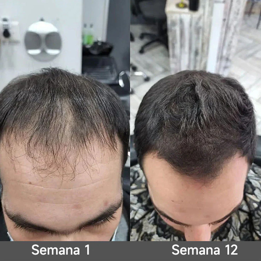 🌿👨‍⚕️ Tienda oficial en EE. UU. 🇺🇸 | 🔥 Champú y acondicionador 2 en 1 PURELORA® de cebolla y romero con complejo activo 15X para el crecimiento capilar: para un cabello con apariencia más gruesa, abundante y fuerte.