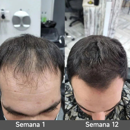 🌿👨‍⚕️ Tienda oficial en EE. UU. 🇺🇸 | 🔥 Champú y acondicionador 2 en 1 PURELORA® de cebolla y romero con complejo activo 15X para el crecimiento capilar: para un cabello con apariencia más gruesa, abundante y fuerte.