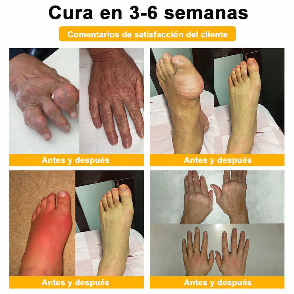 Crema Purelora® con toxina botulínica y veneno de abeja para el alivio del dolor y la regeneración ósea