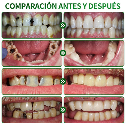 👨‍⚕️🦷✨𝐏𝐔𝐑𝐄𝐋𝐎𝐑𝐀® Gel MicroFill Pept11 Inverso de Cavidad