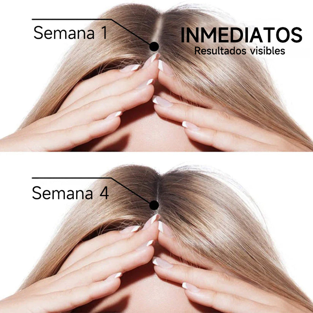 🌿👨‍⚕️ Tienda oficial en EE. UU. 🇺🇸 | 🔥 Champú y acondicionador 2 en 1 PURELORA® de cebolla y romero con complejo activo 15X para el crecimiento capilar: para un cabello con apariencia más gruesa, abundante y fuerte.