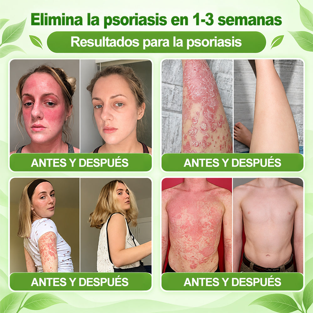 𝐏𝐔𝐑𝐄𝐋𝐎𝐑𝐀® 👩‍⚕️👩‍⚕️ Parche de nanomicroagujas 10 en 1 con péptido antagonista de IL-23R e indirubina (ayuda a reducir el enrojecimiento visible y la descamación, calma la sequedad y la picazón, y favorece el refuerzo y la reparación de la barrera cutánea)