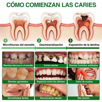 👨‍⚕️🦷✨𝐏𝐔𝐑𝐄𝐋𝐎𝐑𝐀® Gel MicroFill Pept11 Inverso de Cavidad