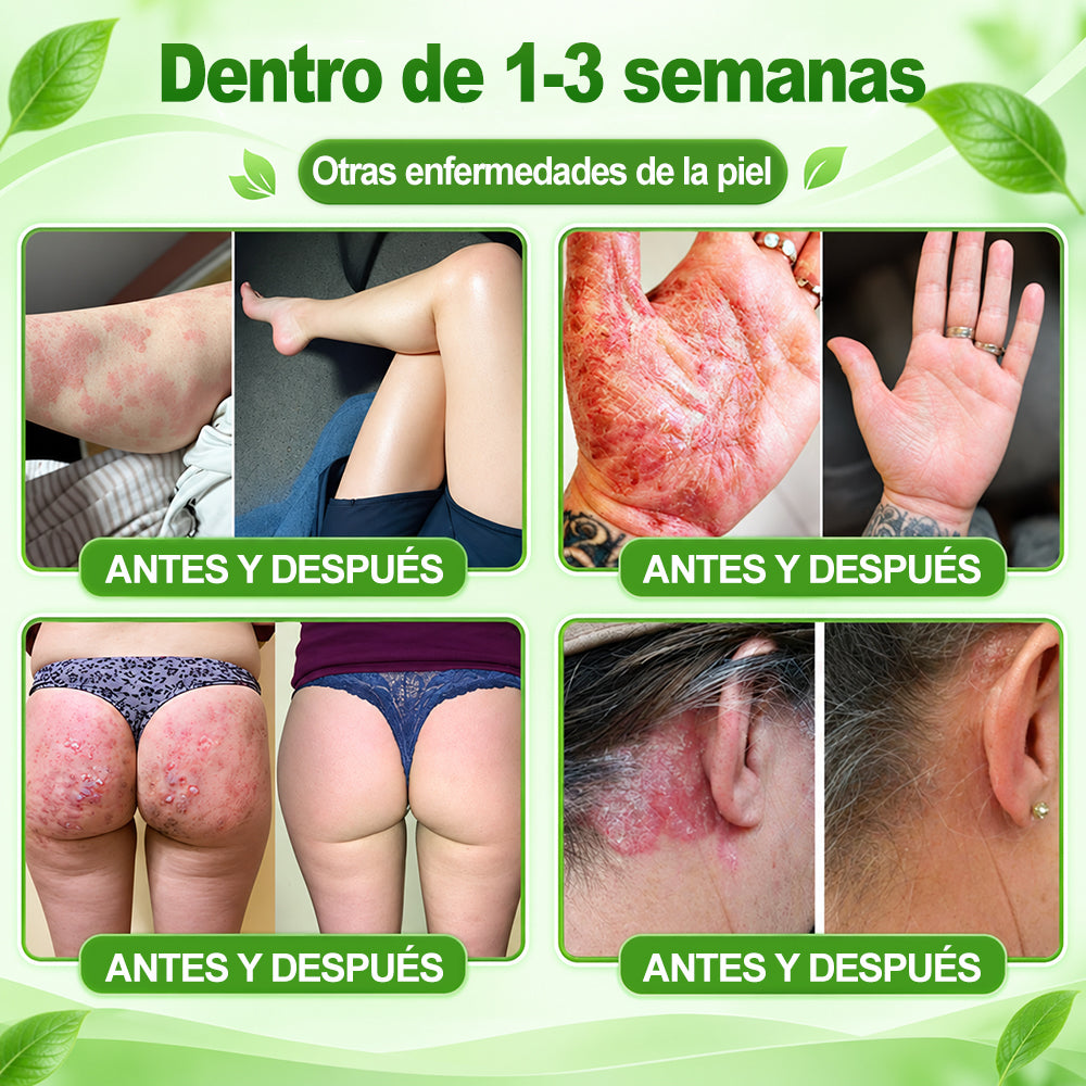 𝐏𝐔𝐑𝐄𝐋𝐎𝐑𝐀® 👩‍⚕️👩‍⚕️ Parche de nanomicroagujas 10 en 1 con péptido antagonista de IL-23R e indirubina (ayuda a reducir el enrojecimiento visible y la descamación, calma la sequedad y la picazón, y favorece el refuerzo y la reparación de la barrera cutánea)