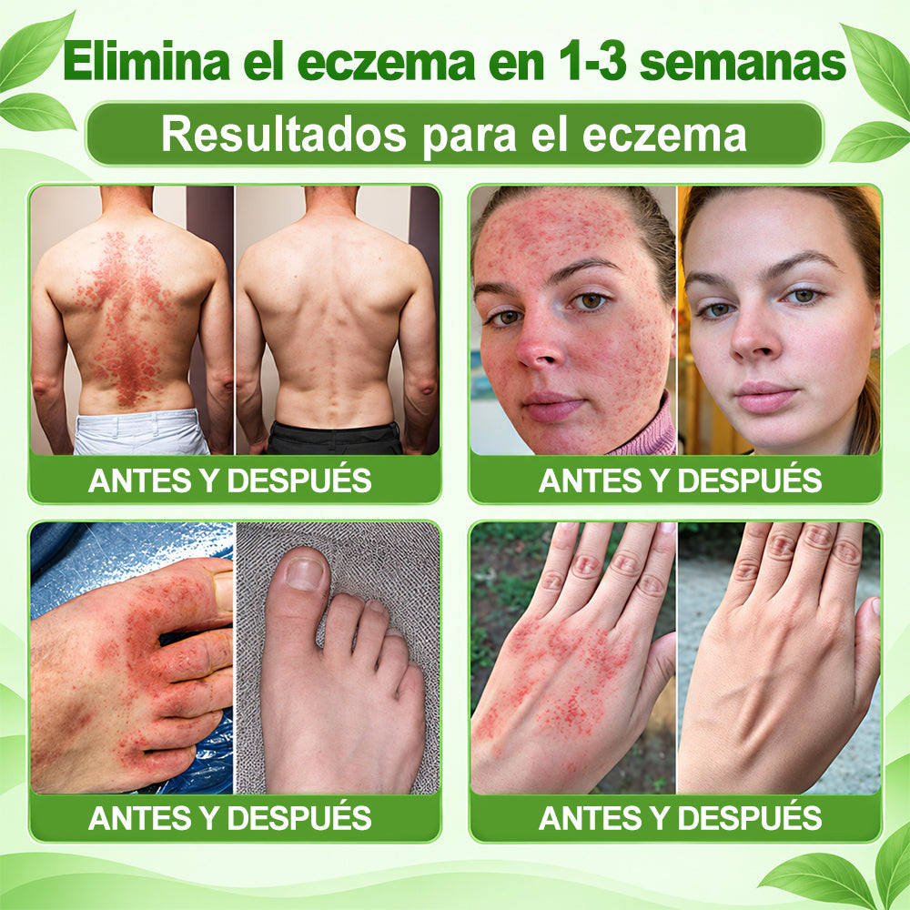 𝐏𝐔𝐑𝐄𝐋𝐎𝐑𝐀® 👩‍⚕️👩‍⚕️ Parche de nanomicroagujas 10 en 1 con péptido antagonista de IL-23R e indirubina (ayuda a reducir el enrojecimiento visible y la descamación, calma la sequedad y la picazón, y favorece el refuerzo y la reparación de la barrera cutánea)