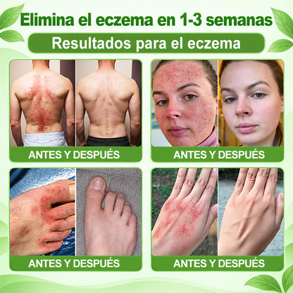 𝐏𝐔𝐑𝐄𝐋𝐎𝐑𝐀® 👩‍⚕️👩‍⚕️ Parche de nanomicroagujas 10 en 1 con péptido antagonista de IL-23R e indirubina (ayuda a reducir el enrojecimiento visible y la descamación, calma la sequedad y la picazón, y favorece el refuerzo y la reparación de la barrera cutánea)