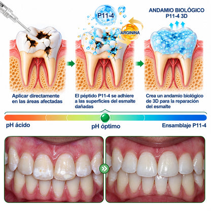 👨‍⚕️🦷✨𝐏𝐔𝐑𝐄𝐋𝐎𝐑𝐀® Gel MicroFill Pept11 Inverso de Cavidad