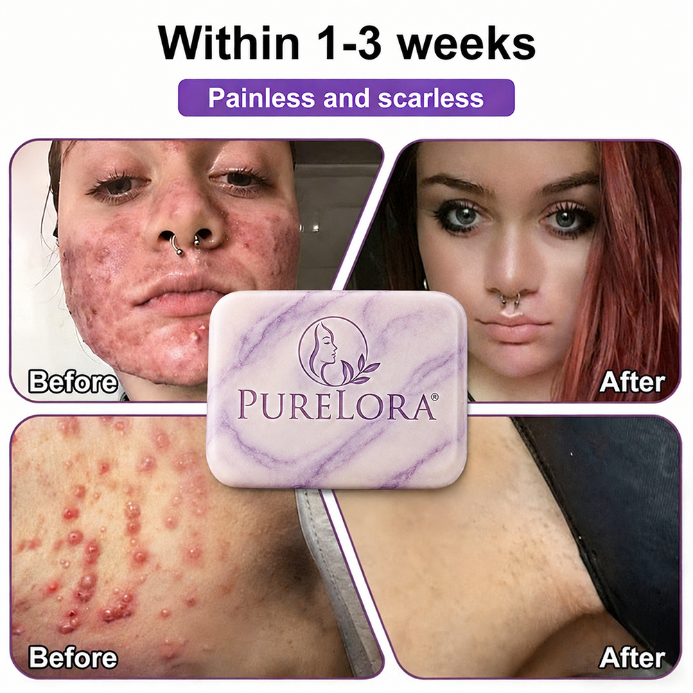 PURELORA® Yoni & Wart Relief Bar Soap | pH-Balanced with Boric Acid & Tea Tree Oil | 2-in-1 Intimate Care & Skin Clarifying Bar | Women's Daily Wash