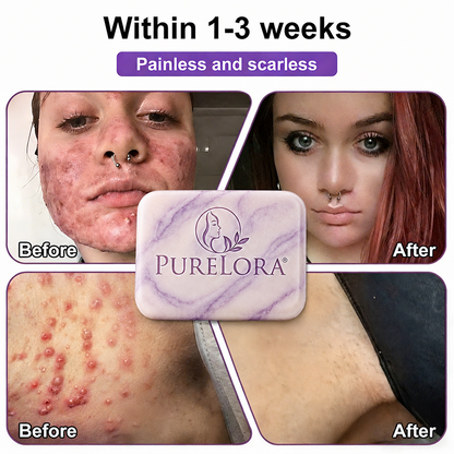 PURELORA® Yoni & Wart Relief Bar Soap | pH-Balanced with Boric Acid & Tea Tree Oil | 2-in-1 Intimate Care & Skin Clarifying Bar | Women's Daily Wash
