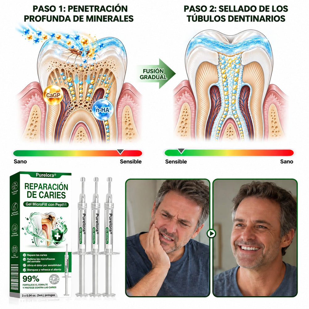 👨‍⚕️🦷✨𝐏𝐔𝐑𝐄𝐋𝐎𝐑𝐀® Gel MicroFill Pept11 Inverso de Cavidad