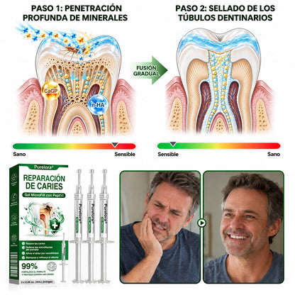 👨‍⚕️🦷✨𝐏𝐔𝐑𝐄𝐋𝐎𝐑𝐀® Gel MicroFill Pept11 Inverso de Cavidad