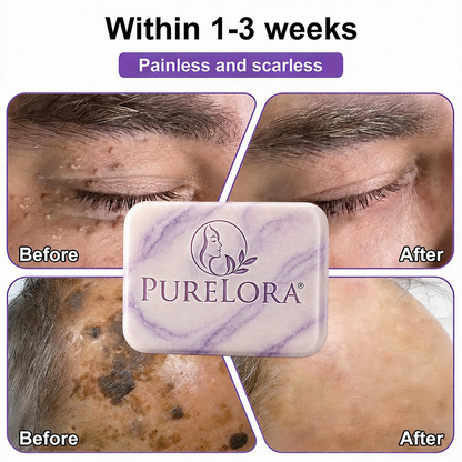 PURELORA® Yoni & Wart Relief Bar Soap | pH-Balanced with Boric Acid & Tea Tree Oil | 2-in-1 Intimate Care & Skin Clarifying Bar | Women's Daily Wash