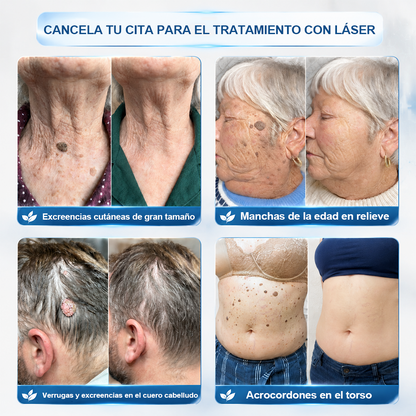 Tienda oficial de la marca | ✅💎 Purelora® Lápiz avanzado de 7 días para la eliminación segura de imperfecciones y cicatrices (aplicador roll-on: sin dolor ni cicatrices)